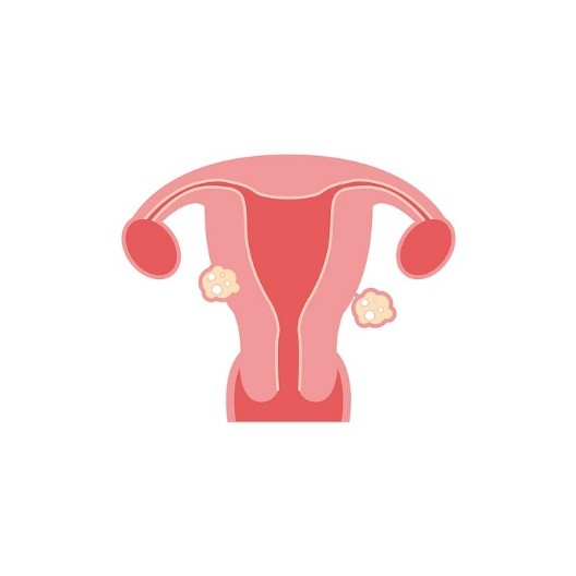 Factores de riesgo y complicaciones de los fibromas uterinos